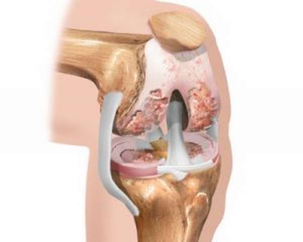 Синдром медиопателлярной складки колена